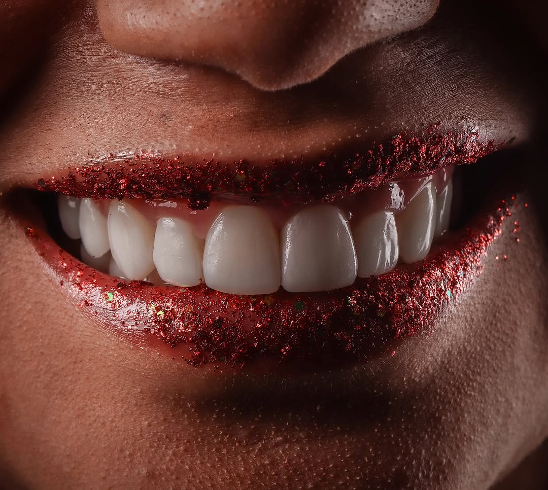 Um novo sorriso. Lentes em resina composta realizadas à mão livre. Detalhe editorial de sorriso