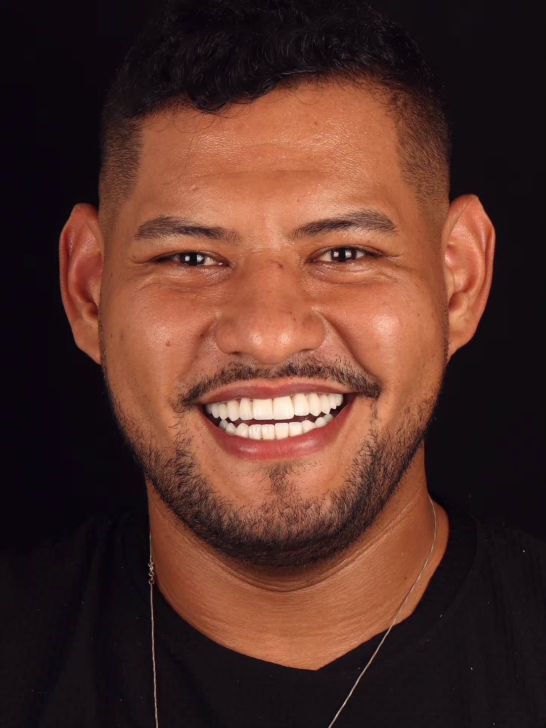 Reabilitação completa. Mordida cruzada e desgaste por bruxismo resolvidos com resina. Sorriso masculino reabilitado